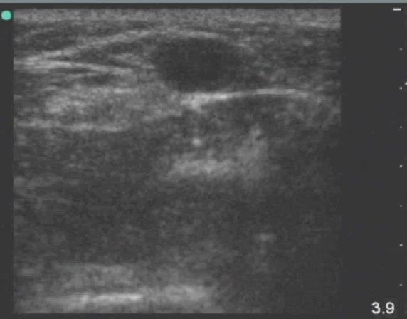 Ultrasound Guidance eadily visualizes vascular tructures rovides