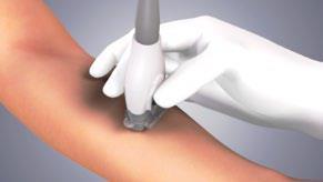 Proper Transducer Hand Placement Holding the probe correctly allows for better vein visualization Very