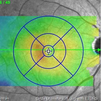 retina from diabetes resulting in a