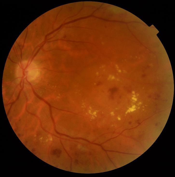 macular thickness Fast