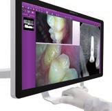 cavities and in endodontic root canal cleaning techniques. Available with or without LED lighting.