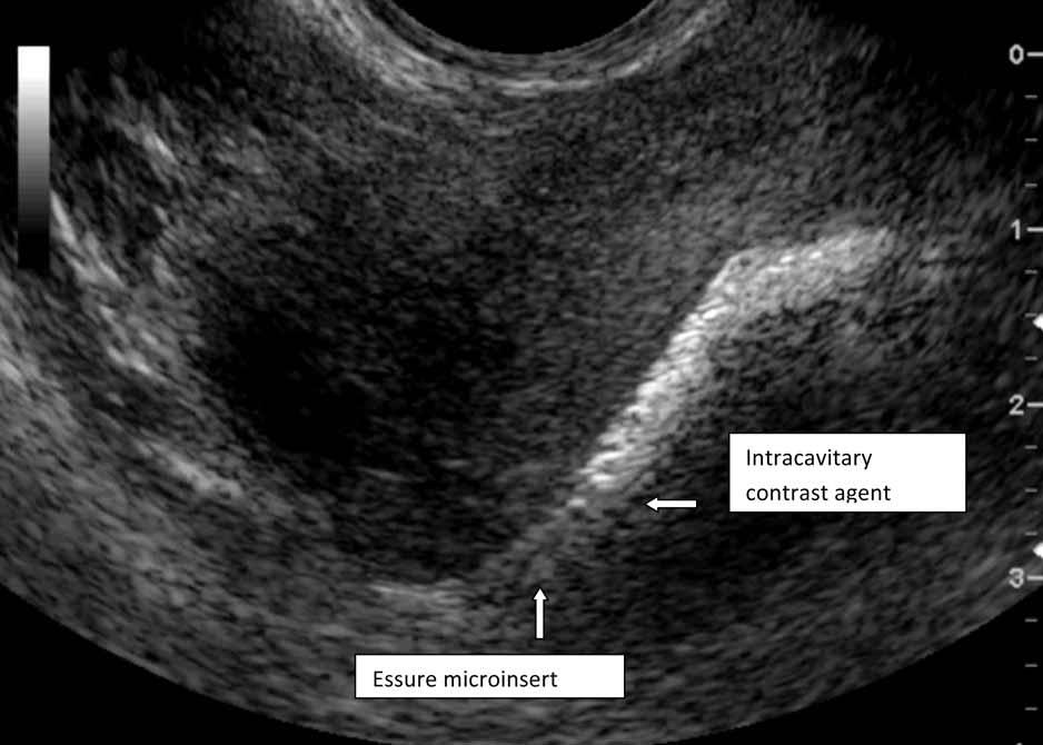 were 76831 (saline infusion sonohysterography) and 58340 (catheterization and introduction of saline or contrast material for saline infusion sonohysterography), and the International Classification