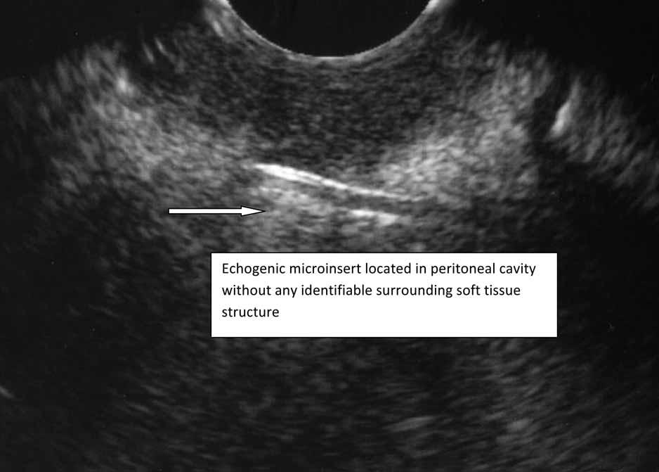uterine anteflexion and soft tissue dystocia as a result of obesity. Two of 3 cases of suspected unsatisfactory placement on scout sonographic examinations were confirmed on hysterosalpingography.