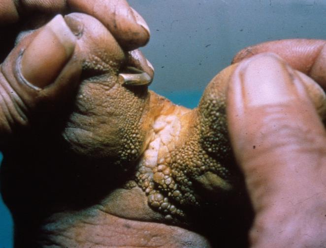 Carefully dry between the toes and skin folds using a small clean towel, swab or cloth How do you treat entry lesions?