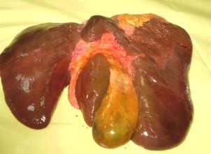 fissure that separates them from central part of segment 6, vertical arch-like fissure between profound and superficial parts of quadrate lobe, pear-shaped gallbladder B A B Figure2: A-Liver surface