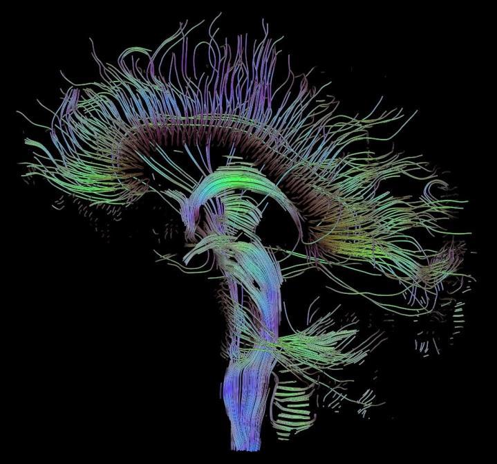 Structural imaging: DTI (diffusion tensor imaging) Technically