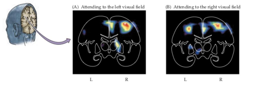Examples: Parietal association cortex Important for visual attention PET and fmri studies suggest that both the right and the left parietal cortices