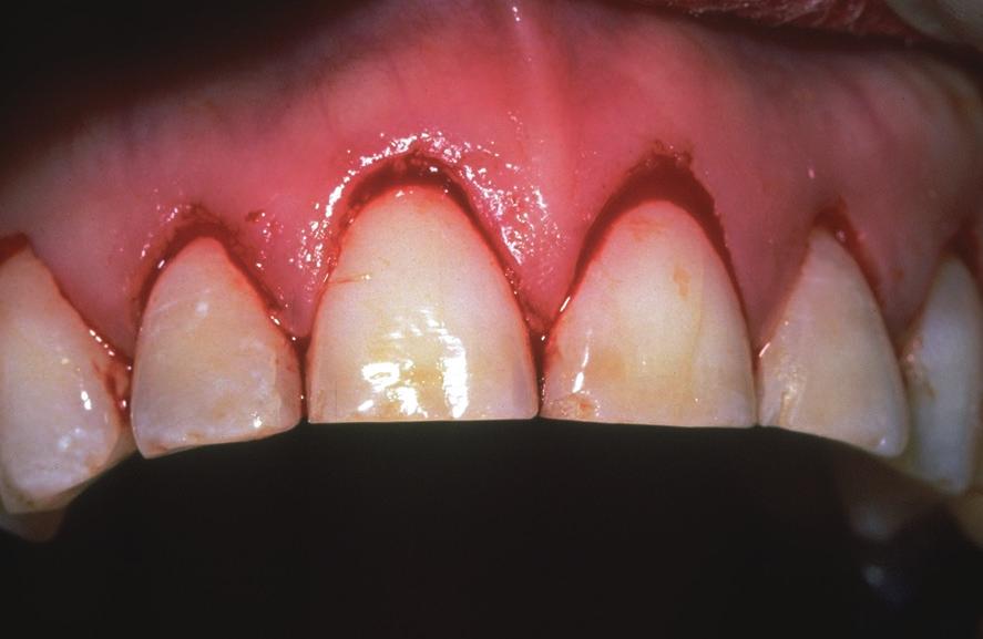 width/length ratio of the central incisors was greater than 100 per cent. This ratio serves to place the central incisors in proportion with the rest of the arch and the face.