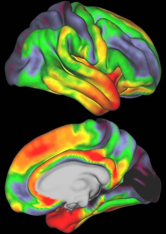 Insular Anterior temporal Medial frontal Occipital