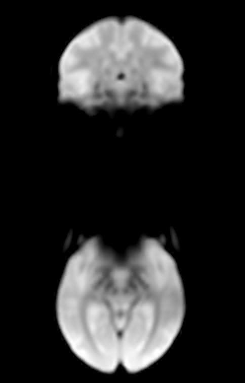 Echo-planar Imaging (EPI) fmri Sequence (T2*