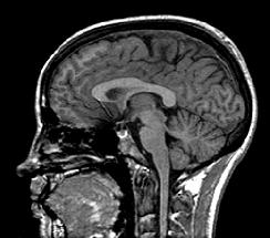Structural MRI FreeSurfer Gray