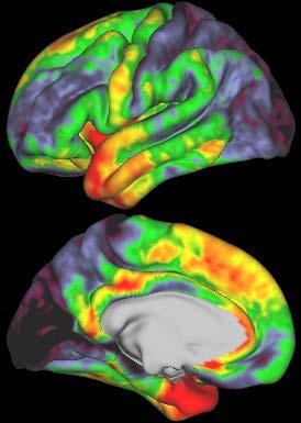 Measuring Cortical Thickness in No/Low Adolescents at Baseline
