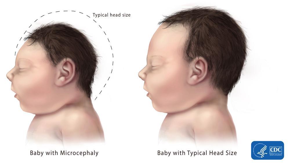 properly during pregnancy or has stopped growing after birth, which results in a smaller head size.