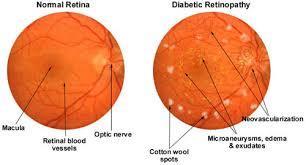 Complications during pregnancy: Retinopathy Pregnancy is a risk factor for diabetic retinopathy.