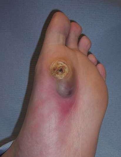 Active Diabetic Foot Problems Ulceration, spreading infection, critical limb ischaemia, gangrene or suspicion of acute Charcot Refer people with