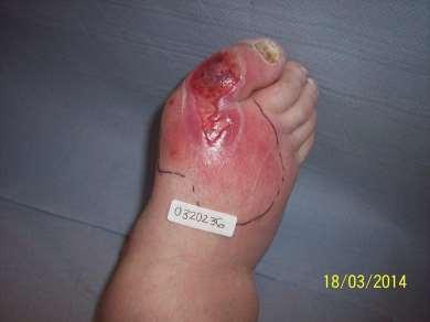 Diabetic Foot Infection Use soft tissue or bone samples