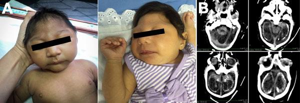 Microcephaly in Infants Pernambuco State,