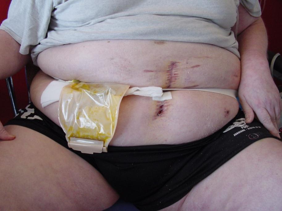 TEMPORARY ILEOSTOMY IN OBESE PATIENTS ANASTOMOSIS
