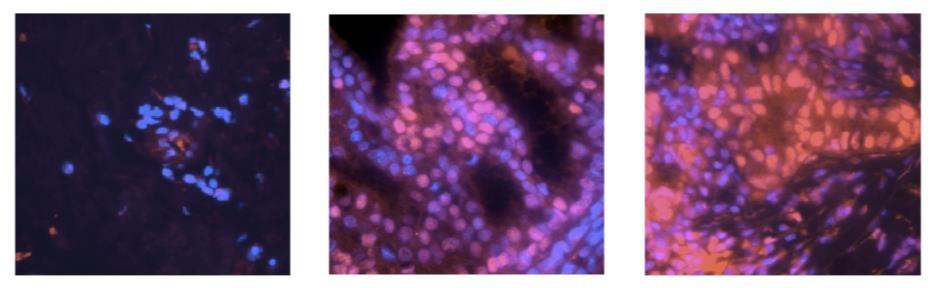 ps62/dapi MYC is stabilized by increased ps62-myc in human breast tumors Normal DCIS (Ductal Carcinoma in Situ) Invasive Zhang et PNAS. In Press Zhang et al.