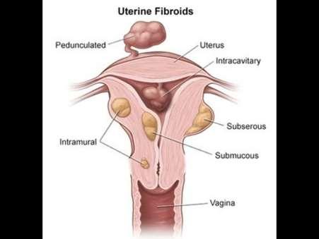 2. Uterine Factor Infertility Causes: Submucous fibroids Endometrial