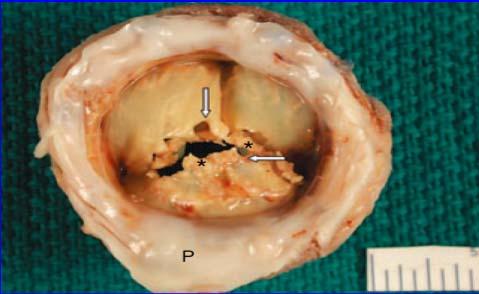 Structural Valve Deterioration Tissue Valves More common Younger patients Altered Ca ++ metabolism Valve type Thickening, calcification, perforation, or