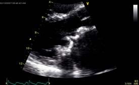 Stenosis/Obstruction Mitral valve parameters: Peak E-wave velocity Mean