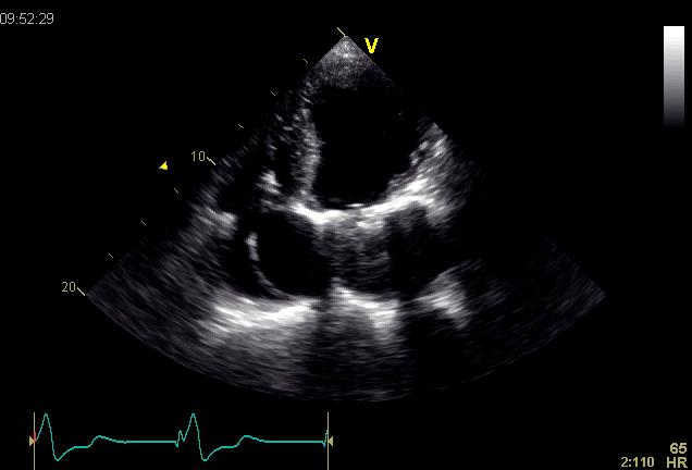 reverberation artifacts/shadowing Differential diagnosis of high valve gradients: True stenosis High