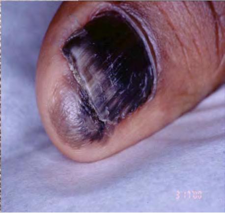 and ABCDEs of nail melanoma