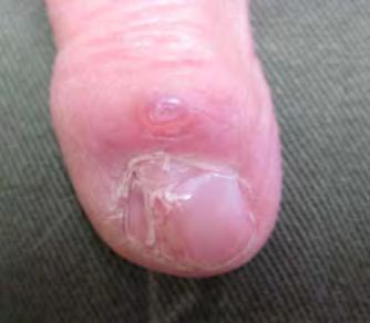 RKNail changes and association of osteoarthritis in digital myxoid cyst.