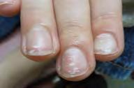 Non-melanocytic pigment in nail Fungus hemorrhage Stains Melanin from nail