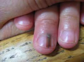 Dermoscopy of pigmented bands in nails Two Steps What is the background color of the band ( brown, black or gray) What are the characteristics of the lines within the band?