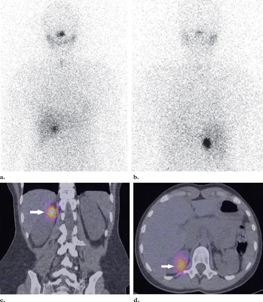 I-131 Whole Body Imaging Differentiation between malignancy and benign changes with SPECT/CT in a patient with thyroid cancer who underwent 131I whole-body imaging to assess for residual recurrent