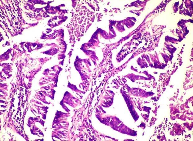 Poorly differentiated adenocarcinoma [H&E, x] D.