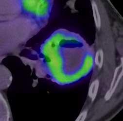 A clinical example: validation study CT PET PET/CT This