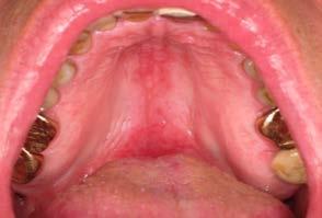 Oral candidosis