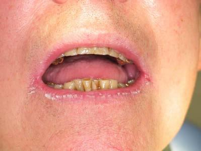 Angular cheilitis Consider fungal or bacterial infection