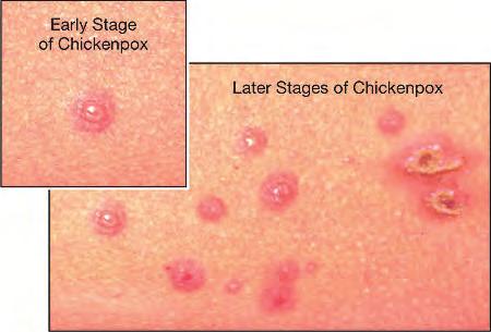 page 3 page 8 Rashes/Skin Diseases Lungs (continued) Chickenpox: A rash of small itchy blisters that start on the stomach or back and spread to the entire body.
