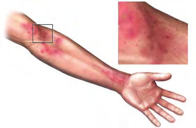 Wash all personal items, including sheets, towels, clothing, and combs in HOT WATER. Scabies: Pimple-like rash caused by small insects called mites found anywhere there are folds. Rash is very itchy.