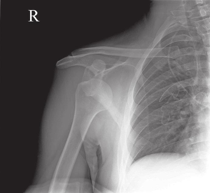 10 2 Examination of the Shoulder Fig. 2.1 Anteroposterior radiograph showing an anterior dislocation of the right shoulder (Courtesy Dilip Malhotra, Bahrain) Palpation Bony landmarks can be palpated