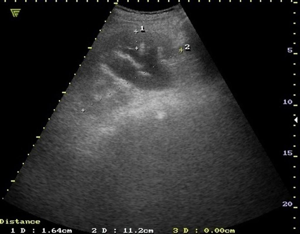 Fig. 7: Left kidney first degree hydronephrosis in renal colic.