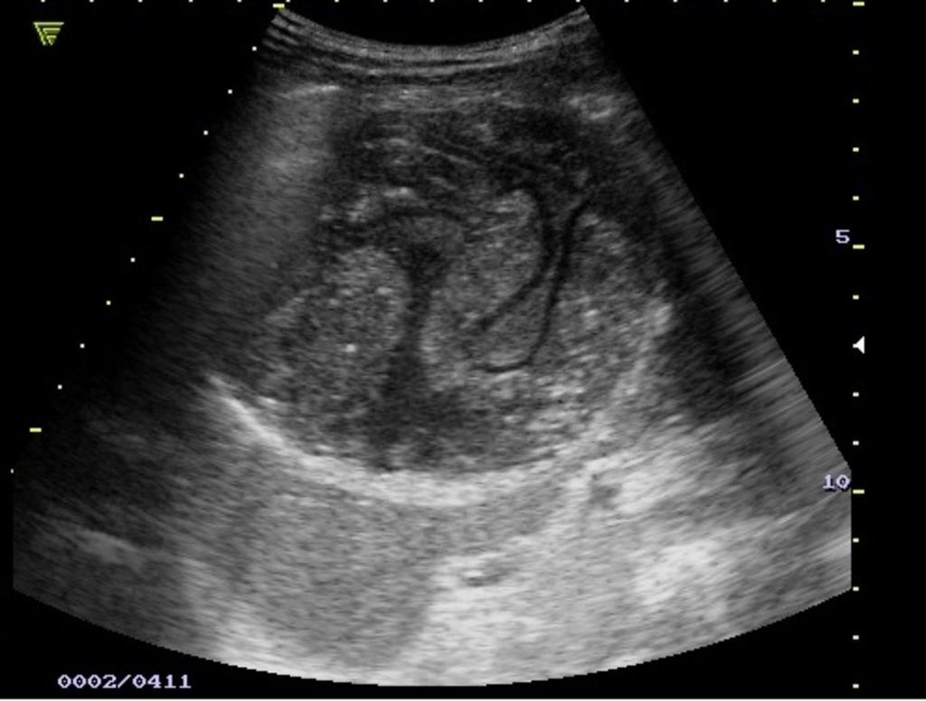 Fig. 8: Large spleen hydatic cyst.