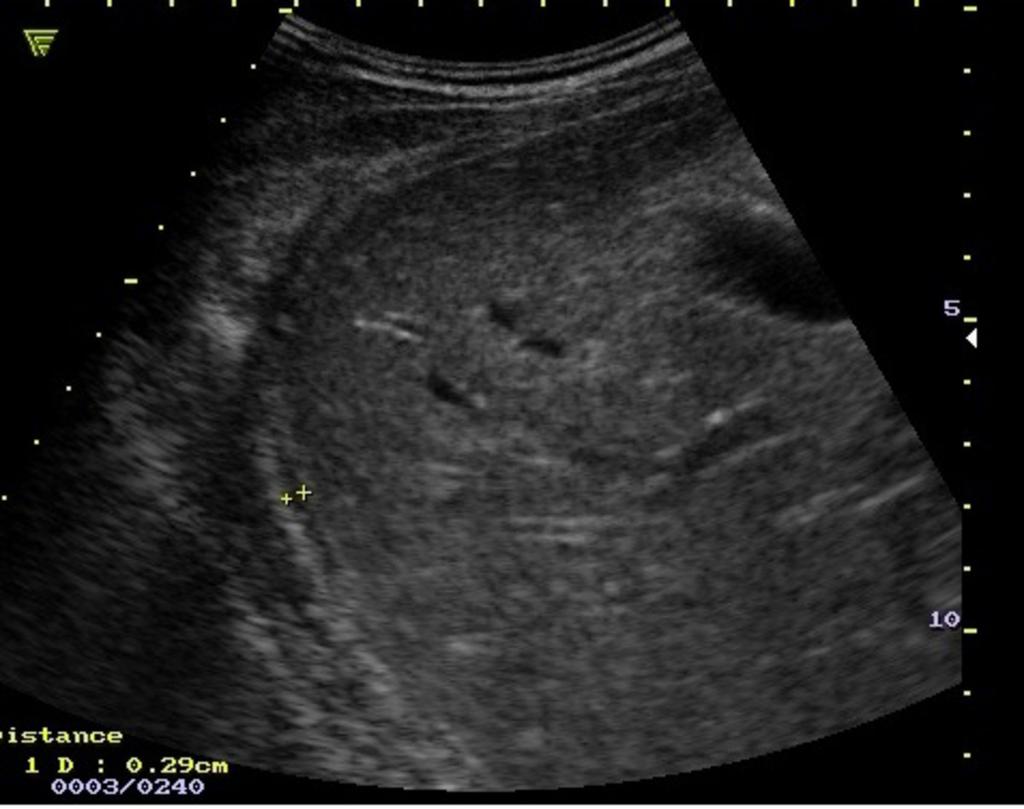 Some of the main advantages of using the ultrasound evaluation in the emergency deprtment are that sonography it is a non-invasive procedure, it has a low dose of radiation, and small, portable