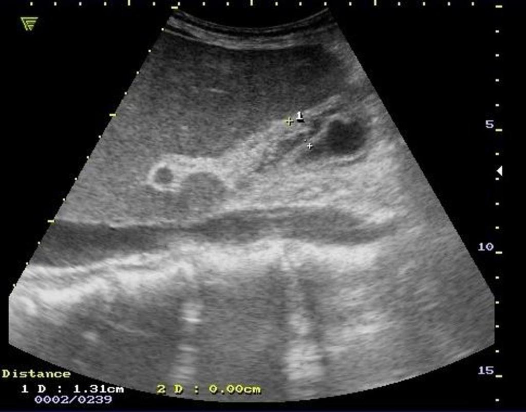 Fig. 1: Small amount of free fluid young male after trauma. Emergency Department Radiology, Clinical Emergency Hospital Sf. Spiridon Iasi, Medical University of Iasi/ Romania 2011 Fig.