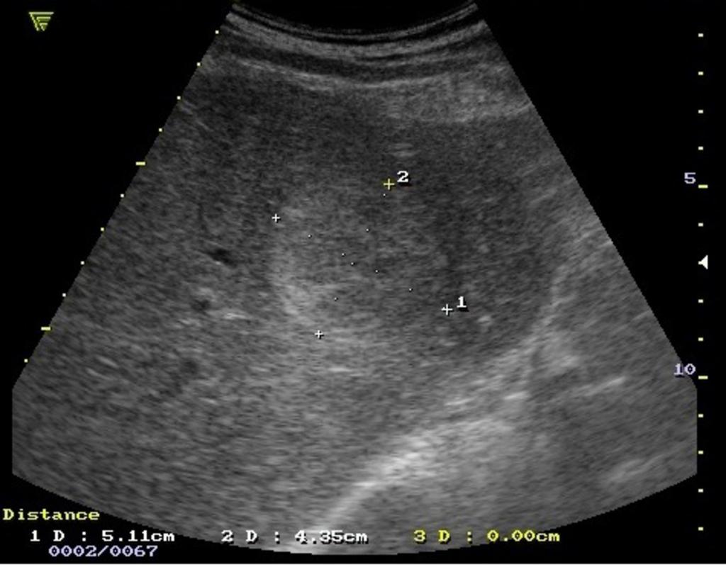 Fig. 5: Cholecystitis in young woman. Emergency Department Radiology, Clinical Emergency Hospital Sf. Spiridon Iasi, Medical University of Iasi/Romania 2011 Fig.