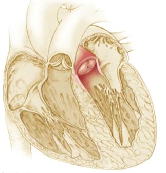 Aortic Valve Stenosis The aortic valve controls blood flow from the heart to the body. In some people, the valve becomes scarred and stiff and has trouble opening.