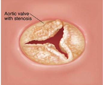 Over time, the extra work can cause the heart muscle to weaken. It can lead to heart failure Causes Aortic stenosis can happen when your aortic valve becomes diseased or damaged.