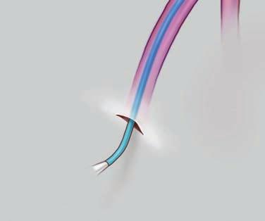 TAVR allows a new valve to be inserted through a catheter. 1.