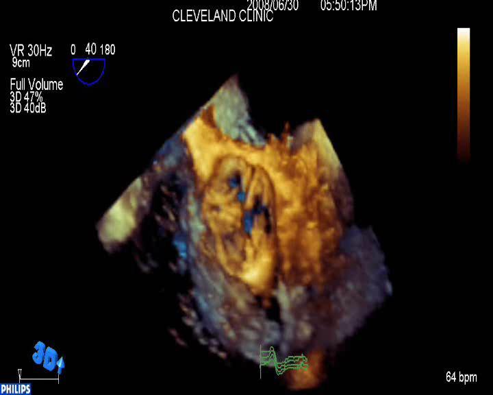 Visualization of Aortic Valve