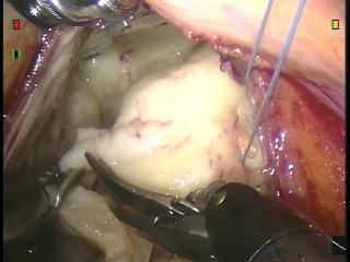 Robotically-Assisted Mitral Valve