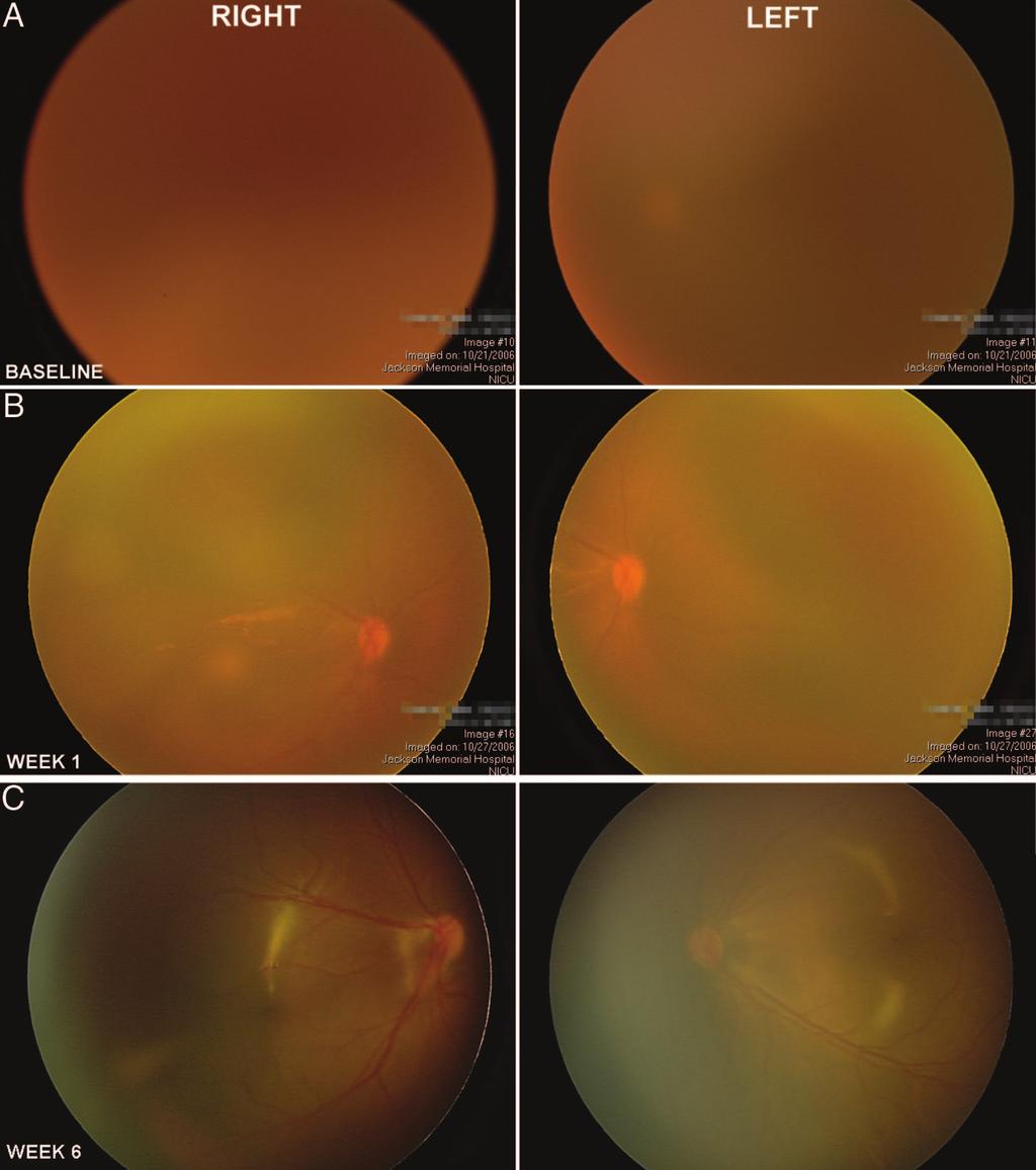 S16 RETINA, THE JOURNAL OF RETINAL AND VITREOUS DISEASES 20